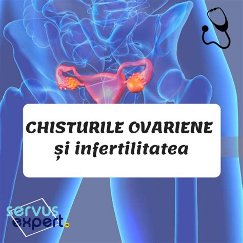 chisturi ovariene poze|CHISTURILE OVARIENE – CE SUNT ELE SI CUM SE POT TRATA